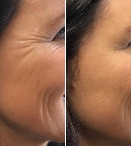 Before and after anti-wrinkle treatment showing smoother crow's feet and reduced fine lines around the eyes.