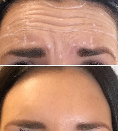 Before and after anti-wrinkle treatment showing a smoother forehead with softened expression lines.