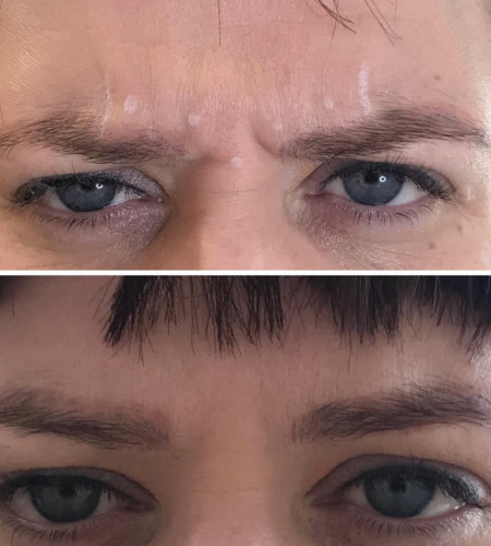 Before and after anti-wrinkle treatment showing reduced frown lines between the eyebrows.