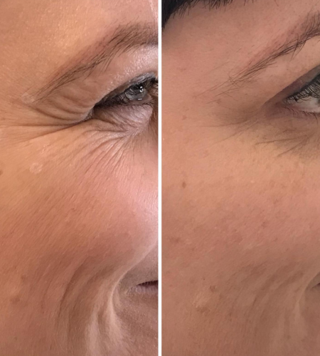 Before and after anti-wrinkle treatment showing smoother crow's feet and softened wrinkles around the eyes.