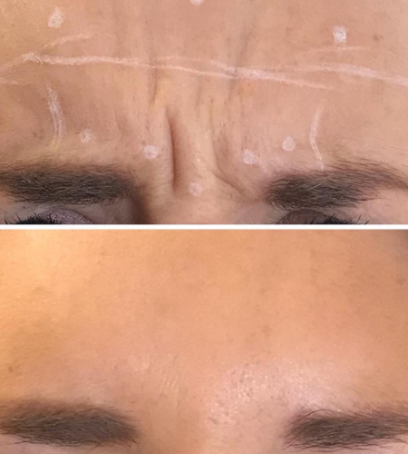 Before and after anti-wrinkle treatment showing a smoother forehead and reduced frown lines.