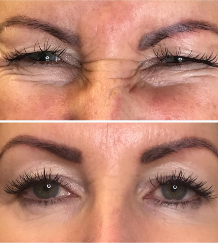 Before and after anti-wrinkle treatment showing a smoother forehead and reduced crow's feet around the eyes.