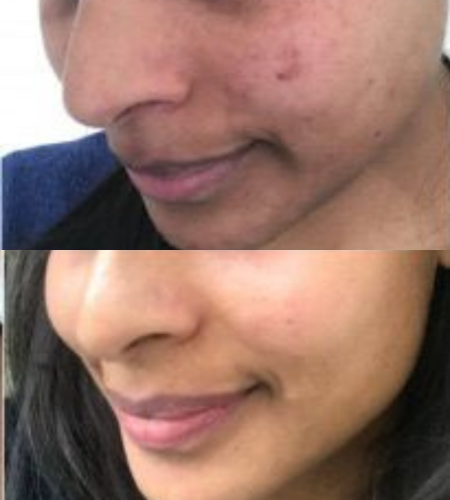 Before and after a medical-grade chemical peel showing a clearer, smoother and more even skin tone.
