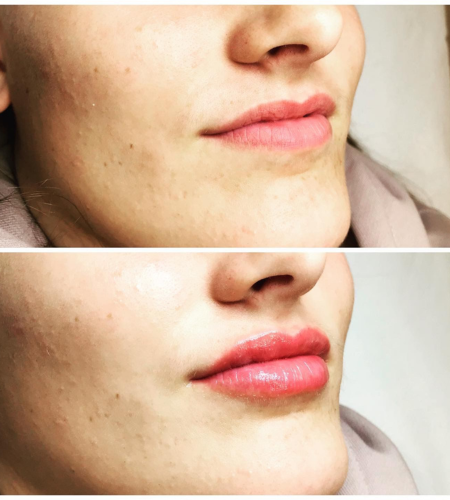 Before and after dermal filler treatment showing enhanced lip volume with natural-looking definition and shape.
