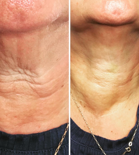 Before and after polynucleotide treatment showing improved skin quality and reduced fine lines on the neck.