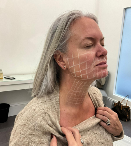 Client prepared for a Skinvive treatment with facial mapping to achieve smoother, healthier-looking and more hydrated skin.
