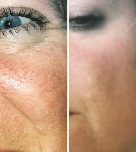 Before and after ThermaVein treatment showing the reduction of visible thread veins for a clearer, more even complexion.