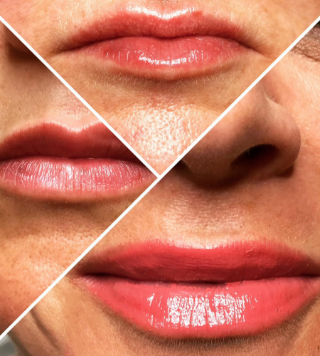 Before and after dermal filler treatment showing enhanced lip volume with natural-looking shape and definition.
