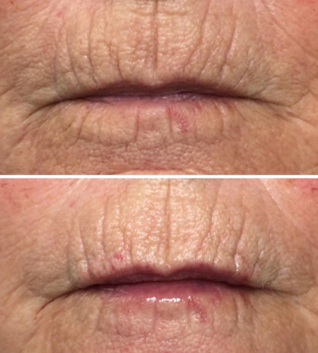 Before and after dermal filler treatment showing improved lip hydration with smoother lip texture and definition.