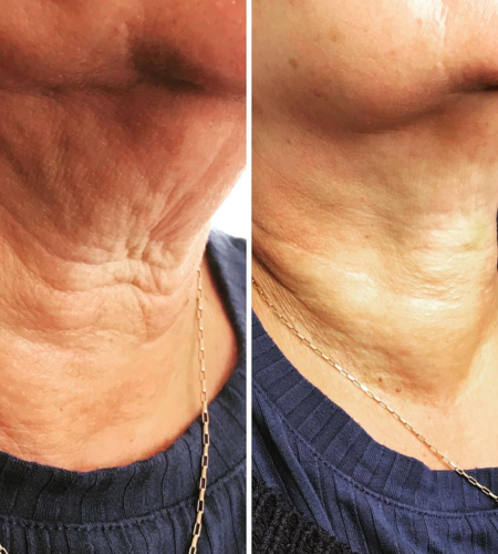 Before and after polynucleotide treatment showing smoother, firmer skin and reduced fine lines on the neck.