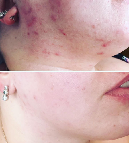 Before and after prescription-strength skincare treatment showing clearer skin with reduced acne and improved skin texture.