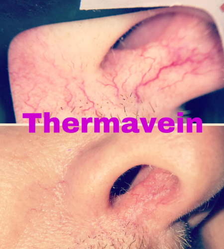 Before and after ThermaVein treatment showing a reduction in visible thread veins around the nose.