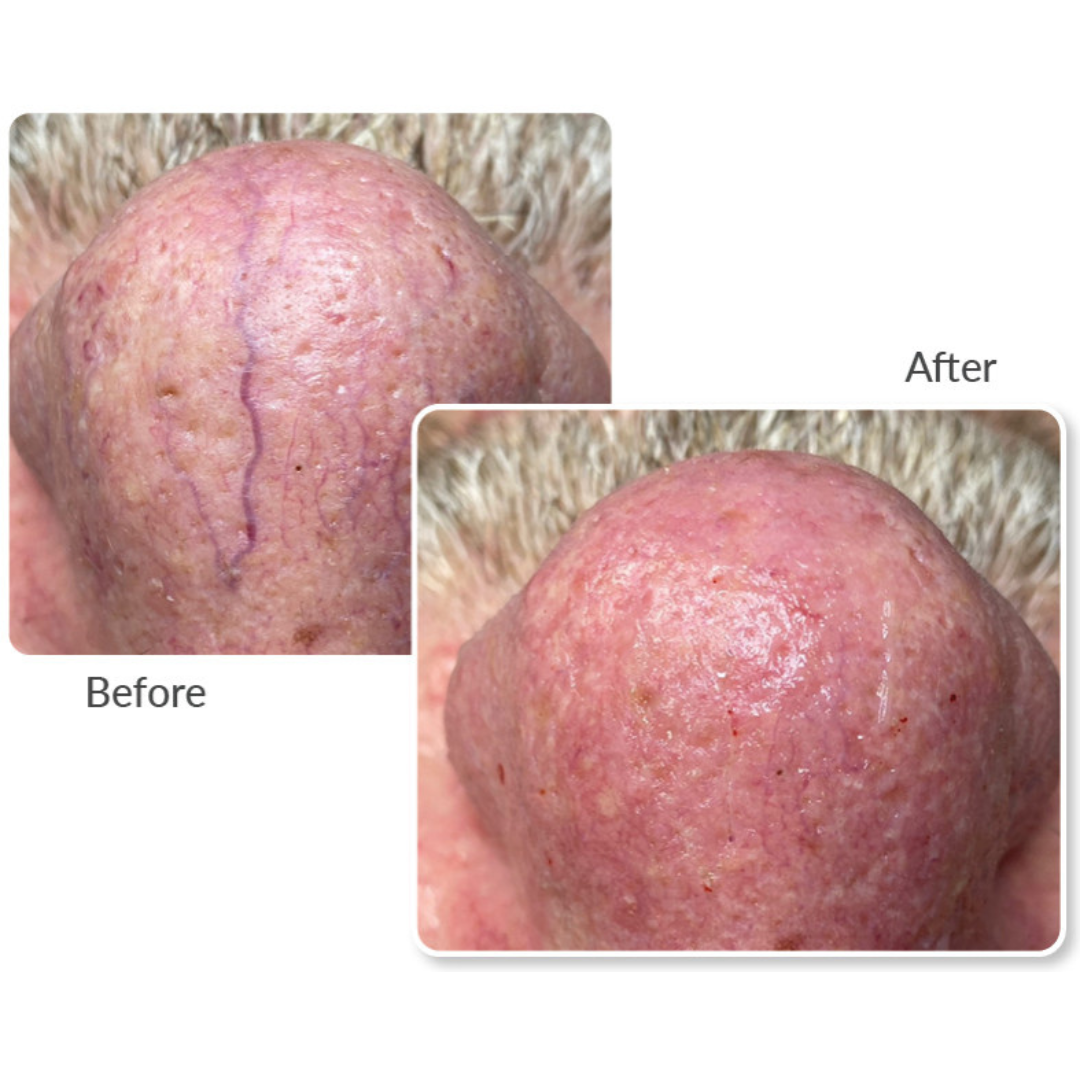 Before and after ThermaVein treatment showing reduced thread veins on the nose for a clearer, more even skin tone.